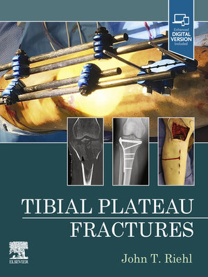 cover image of Tibial Plateau Fractures--E-Book